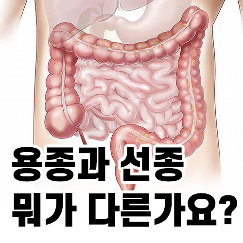 대장용종